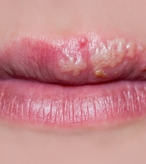 Natural Ways To Treat Herpes Outbreak Natural Ways To Treat Herpes Outbreak