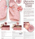 Facts and details about Chronic Obstructive Pulmonary Disease infographic