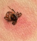 Tick Bite