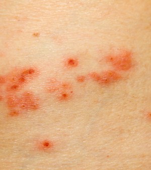 Top 10 Ways to Naturally Heal Shingles