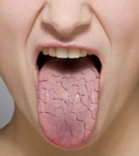 dry-mouth