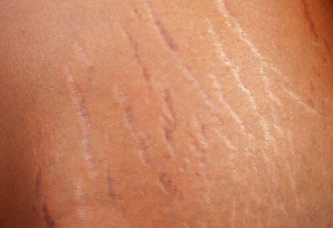 12 Natural Ways to Get Rid of Ugly Stretch Marks (#9 is Pretty Weird