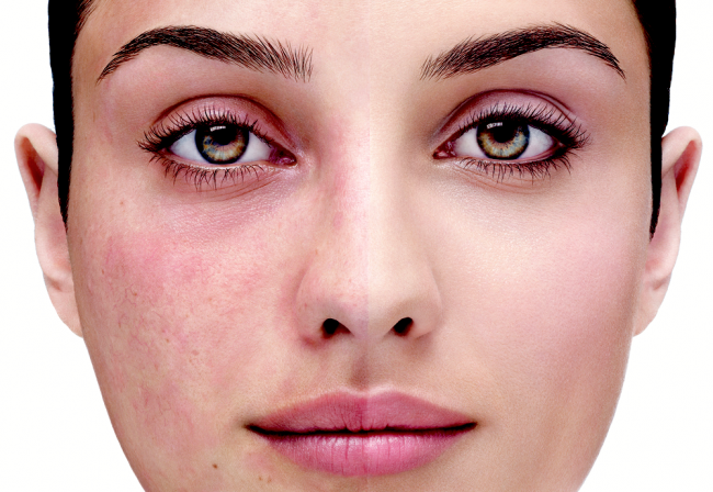 22 Natural Treatments For Rosacea (#15 is Outrageously ...