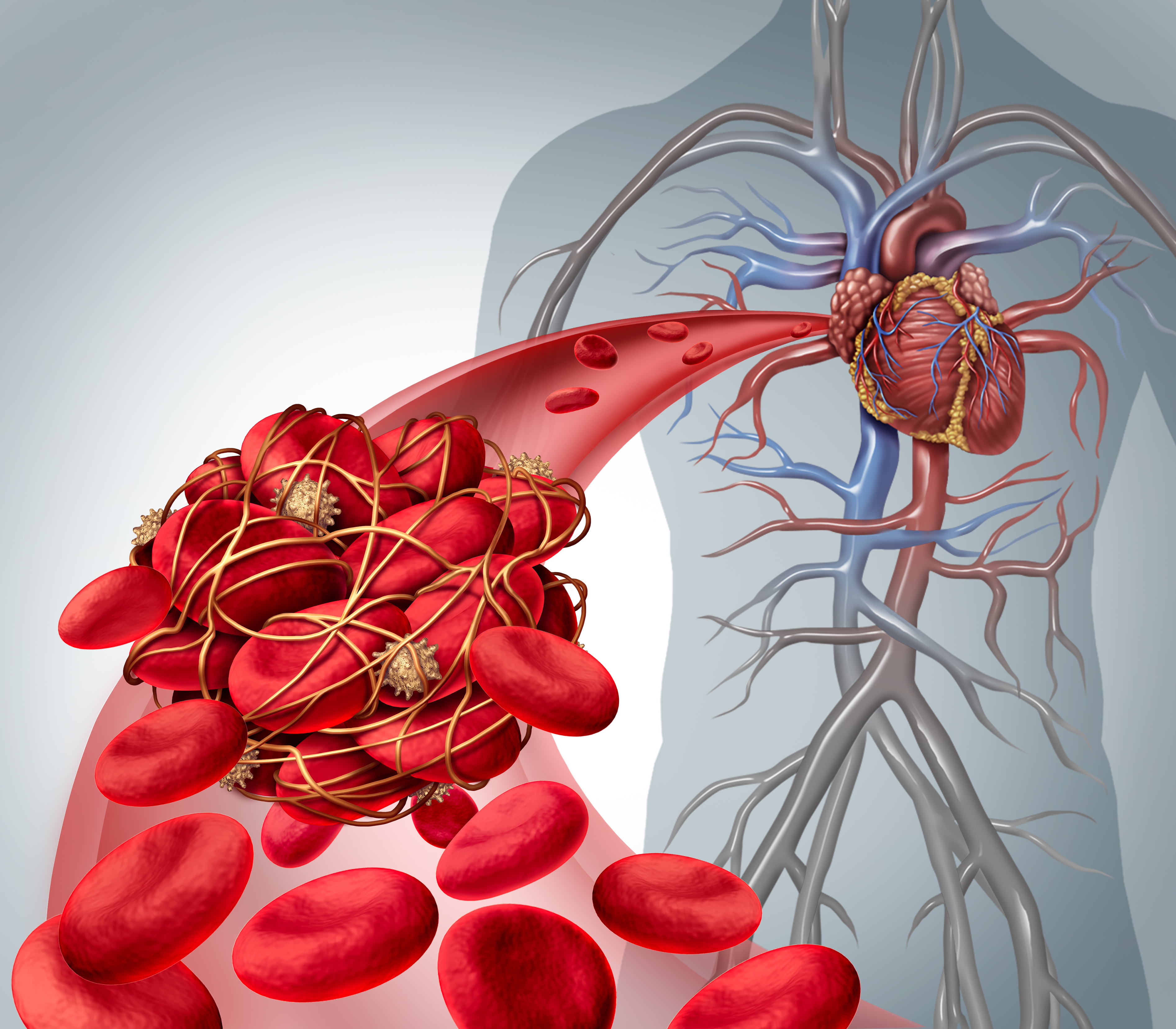 Тромбозы и эмболии артерий. Стаз крови.