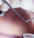 Beware The Danger: 10 Things You Didn't Know About Silver Fillings Video