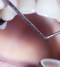 Beware The Danger: 10 Things You Didn't Know About Silver Fillings Video