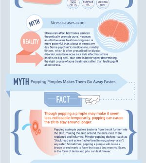 Acne-Related Myths Vs. Real Facts Infographic